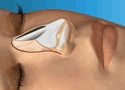 Virtual Nose Job Surgery